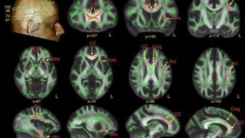 Study reveals subtle brain differences in men with autism