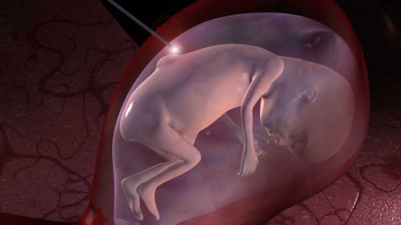 Study on use of umbilical cord vs. biocellulose film for antenatal spina bifida repair