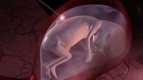 Study on use of umbilical cord vs. biocellulose film for antenatal spina bifida repair