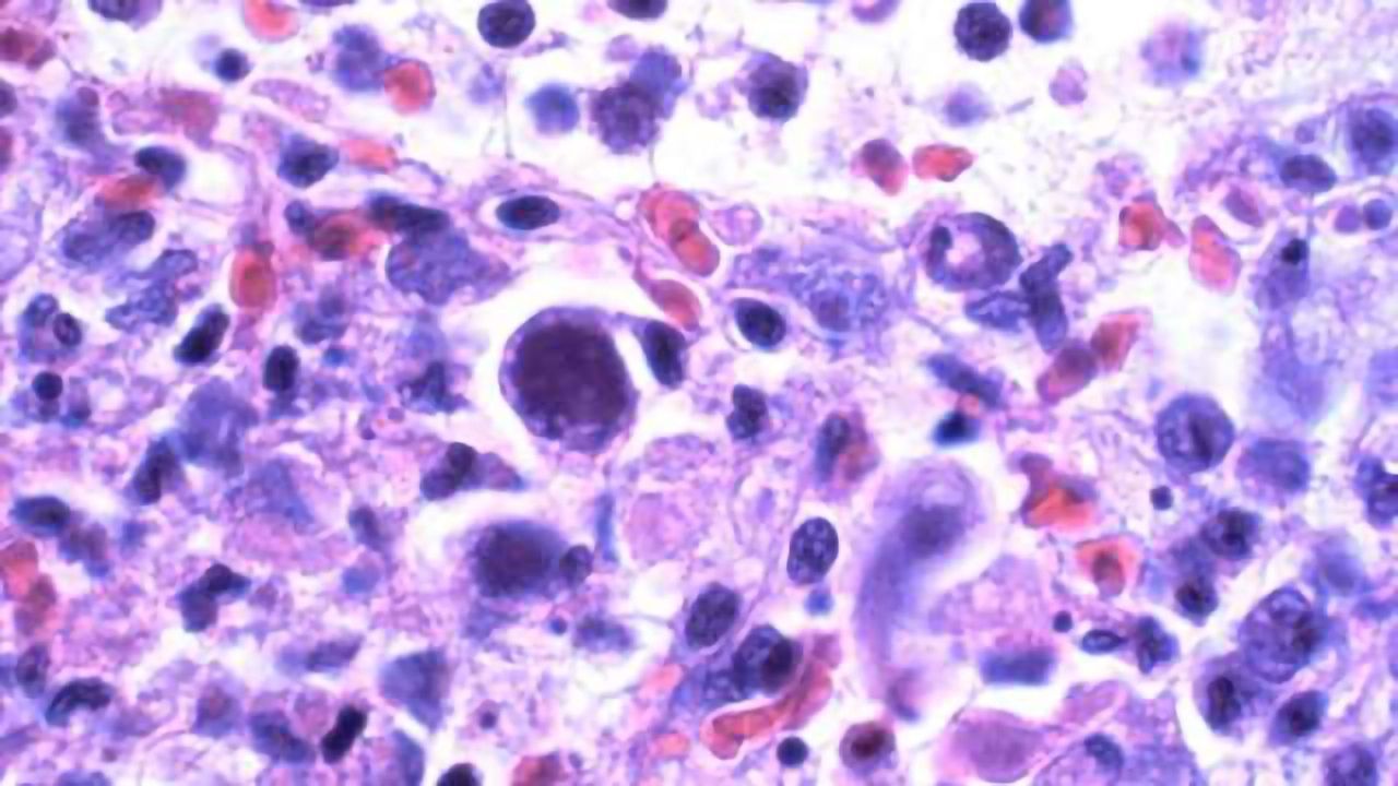 Some chronic viral infections could contribute to cognitive decline with aging