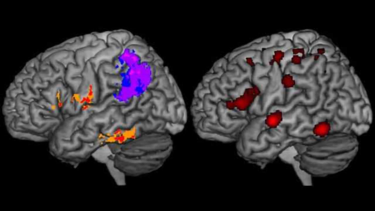 What goes wrong in the brain when someone can't spell