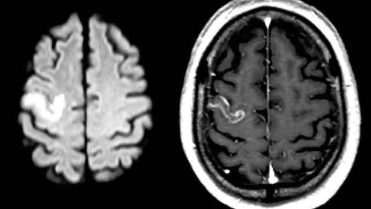 Future help for stroke patients with language problems