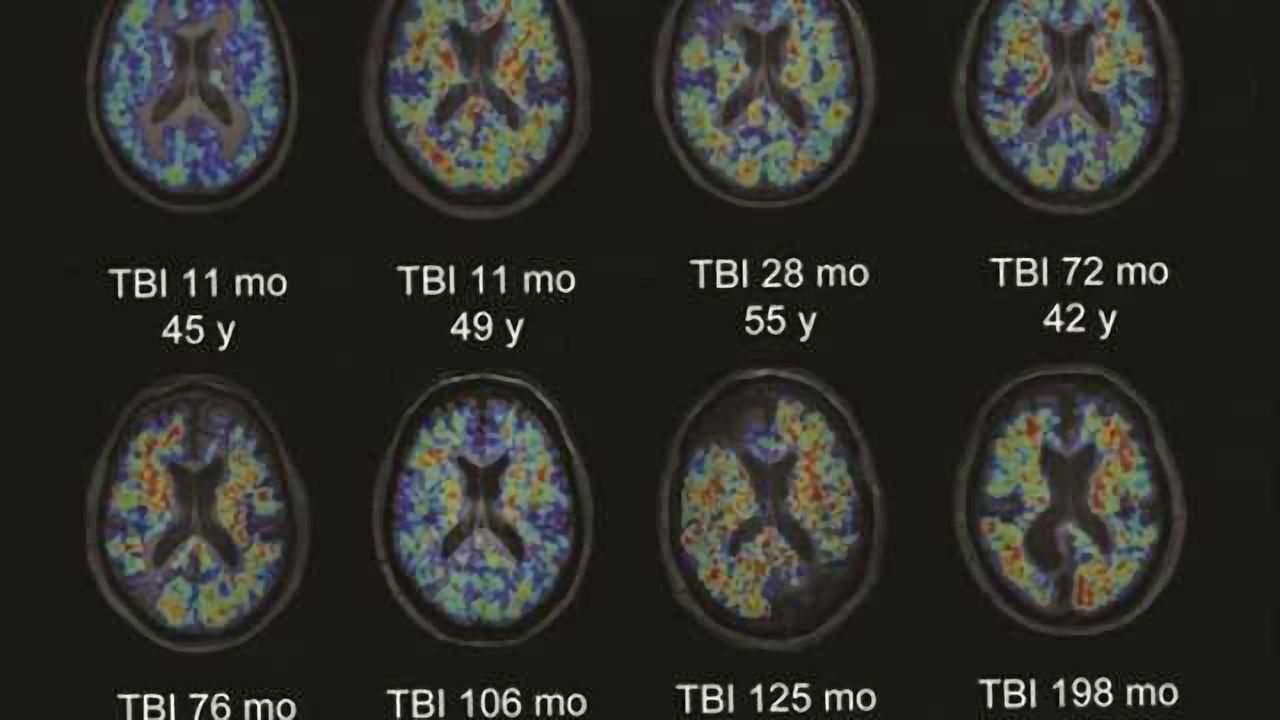 Head injury patients develop brain clumps associated with Alzheimer's disease