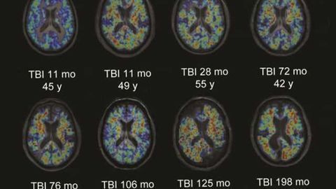 Head injury patients develop brain clumps associated with Alzheimer's disease