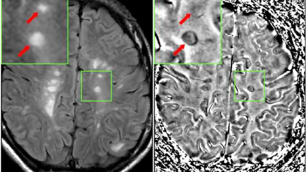 Predicting who will develop multiple sclerosis