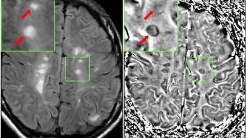 Predicting who will develop multiple sclerosis