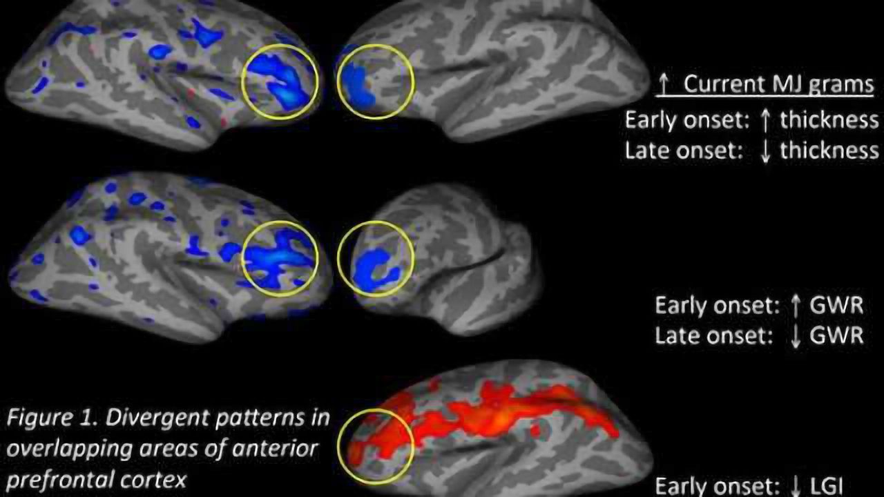 Starting age of marijuana use may have long-term effects on brain development