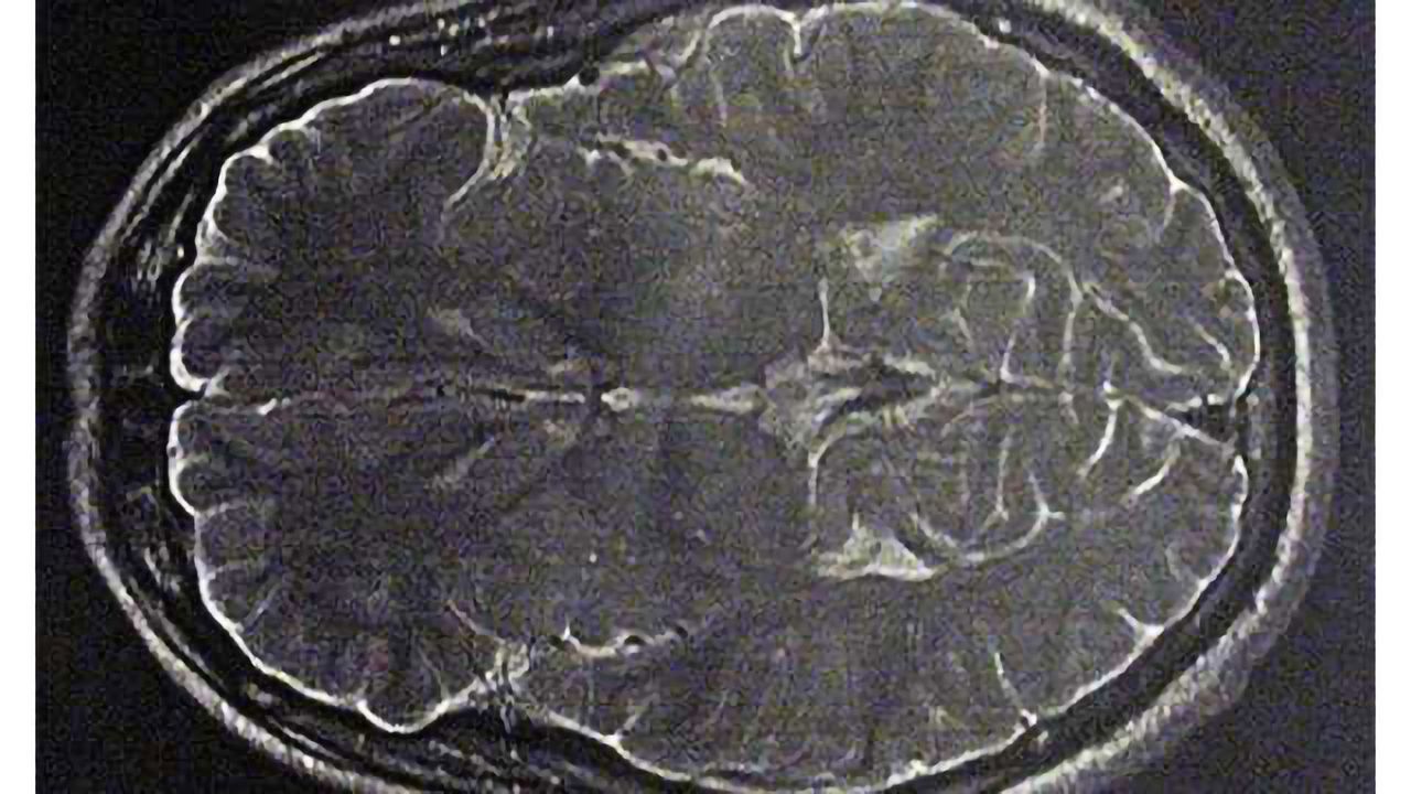 Novel neuroprotective therapy found to enhance memory