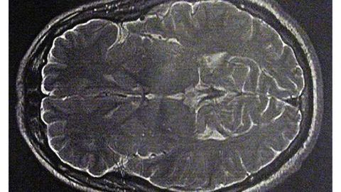 Novel neuroprotective therapy found to enhance memory