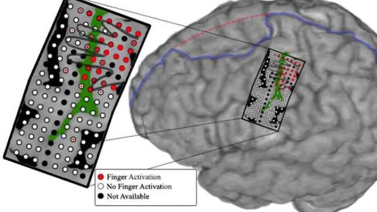 Mind-controlled prosthetic arm moves individual 'fingers'