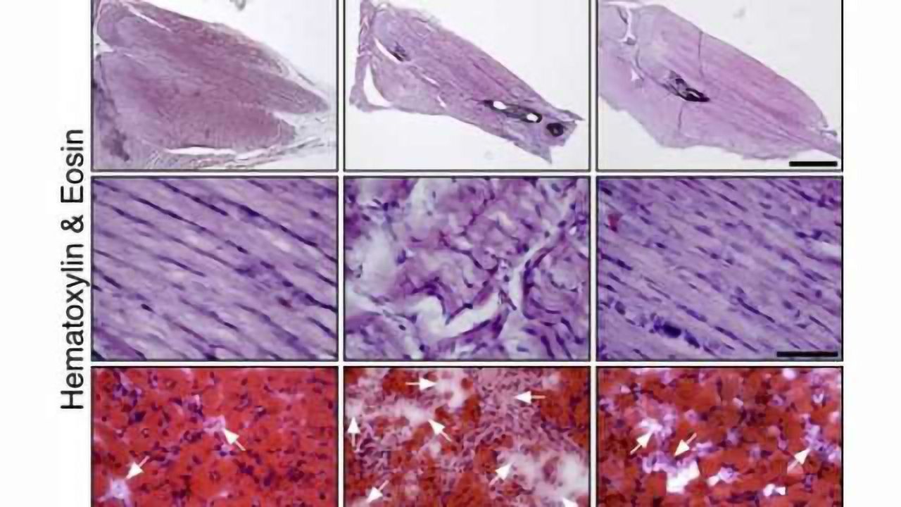 Study unveils new therapeutic target for spinal muscular atrophy