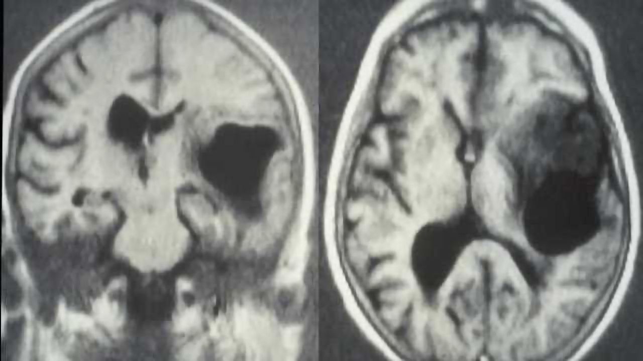 Biochemical alteration responsible for brain tumor resistance identified
