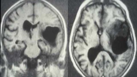 Biochemical alteration responsible for brain tumor resistance identified