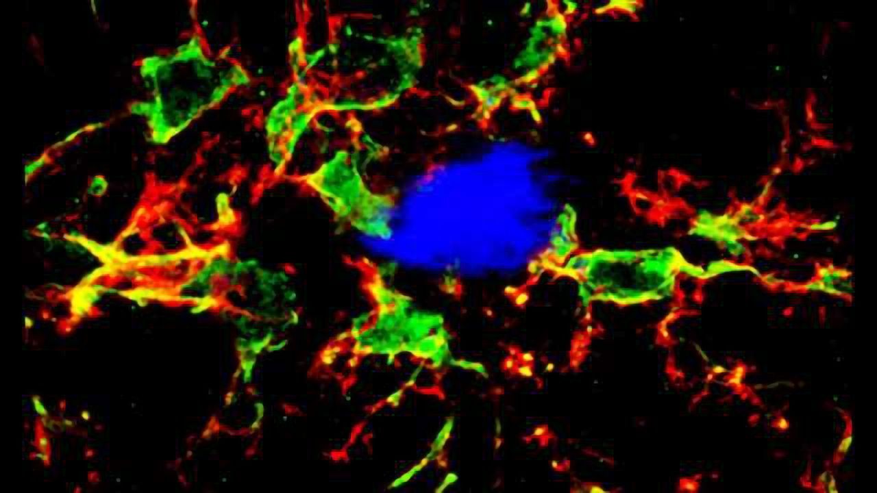 Body’s immune system may play larger role in Alzheimer’s disease than thought
