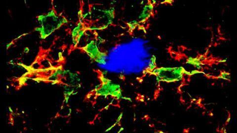 Body’s immune system may play larger role in Alzheimer’s disease than thought