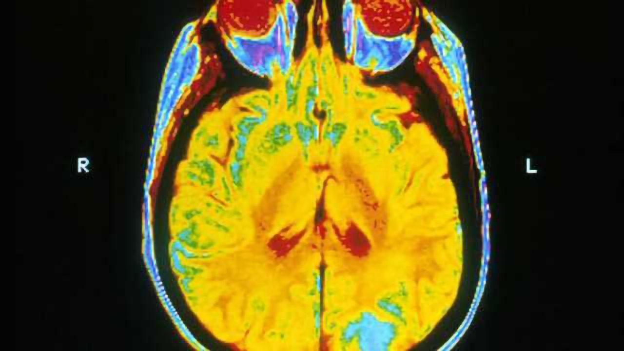 Two forms of radiosurgery for brain metastases are equally effective