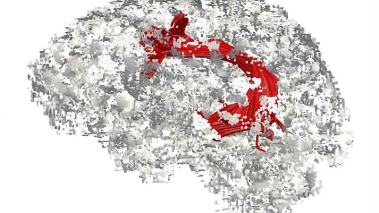 Dementia plaques attack language center of brain