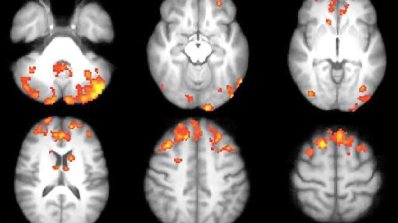 Video games improve brain connections in multiple sclerosis patients