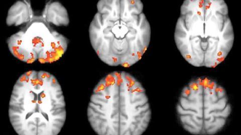 Video games improve brain connections in multiple sclerosis patients