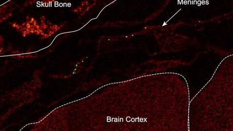 GI tract bacteria help decrease stroke