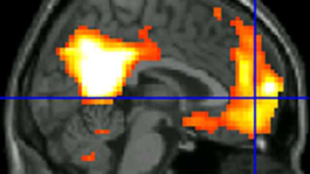 Brain changes seen in veterans with PTSD after mindfulness training