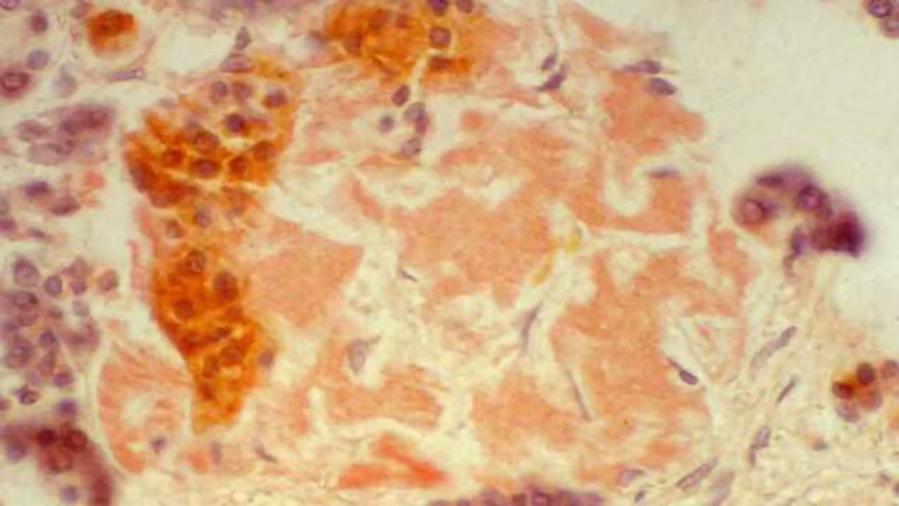 Presence of hormone at key developmental period may point to origin of type 2 diabetes in kids