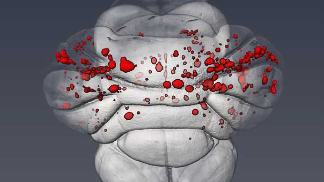 Molecular cause of common cerebrovascular disease described in study