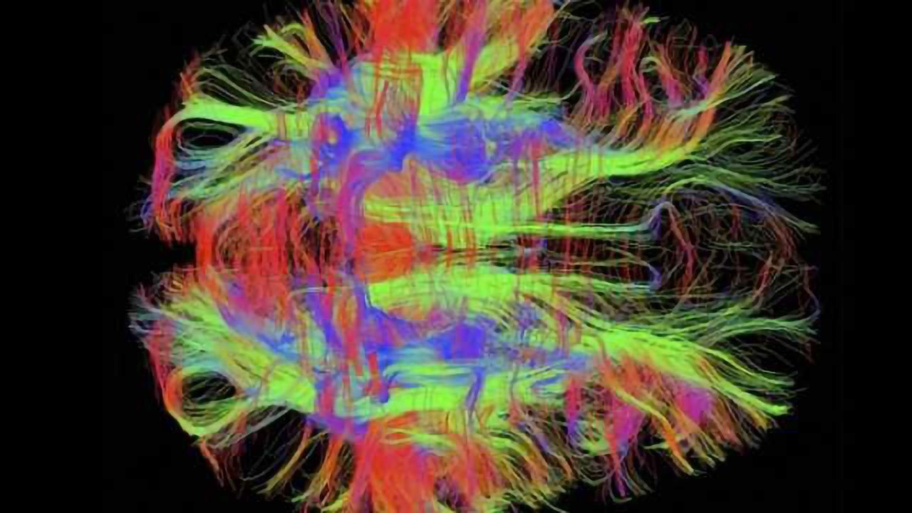 Altered brain communication could be predictive marker of dementia in Parkinson's disease
