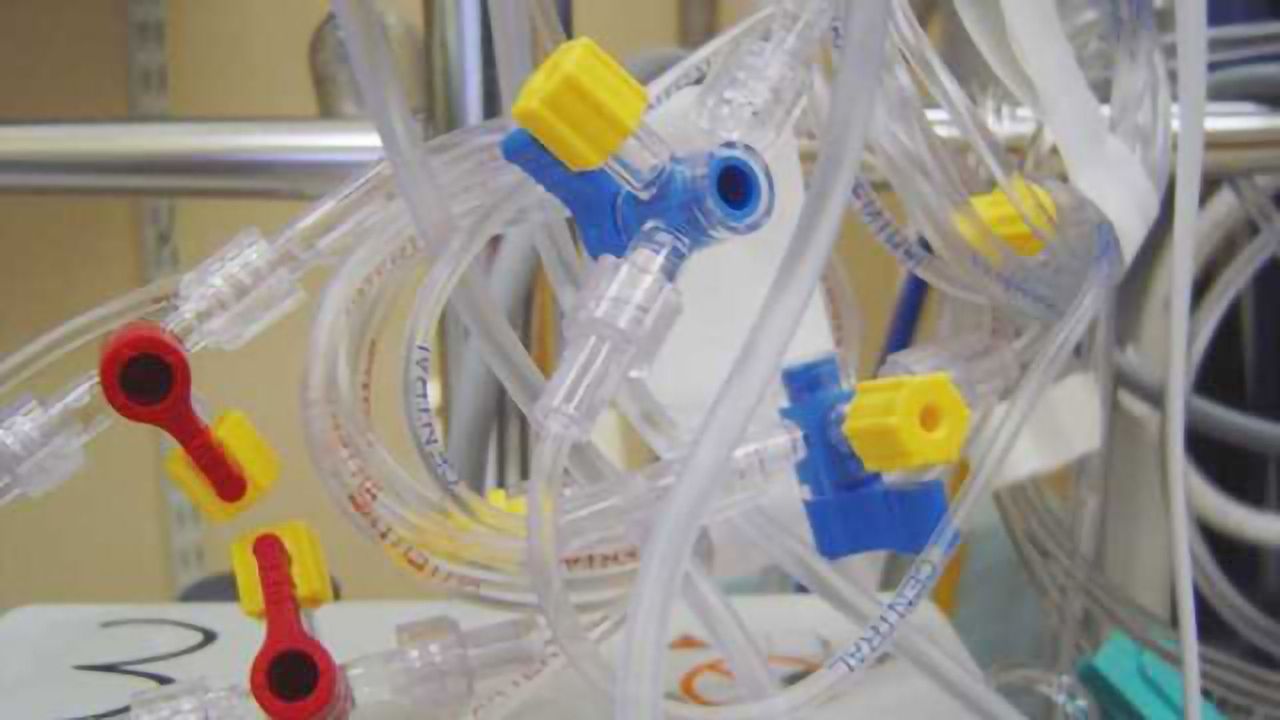 Attention deficit after kids' critical illness linked to plasticizers in medical tubes
