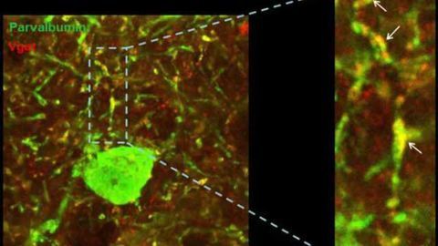 Rhythm of oscillations in cerebral cortex, key to understanding Down syndrome