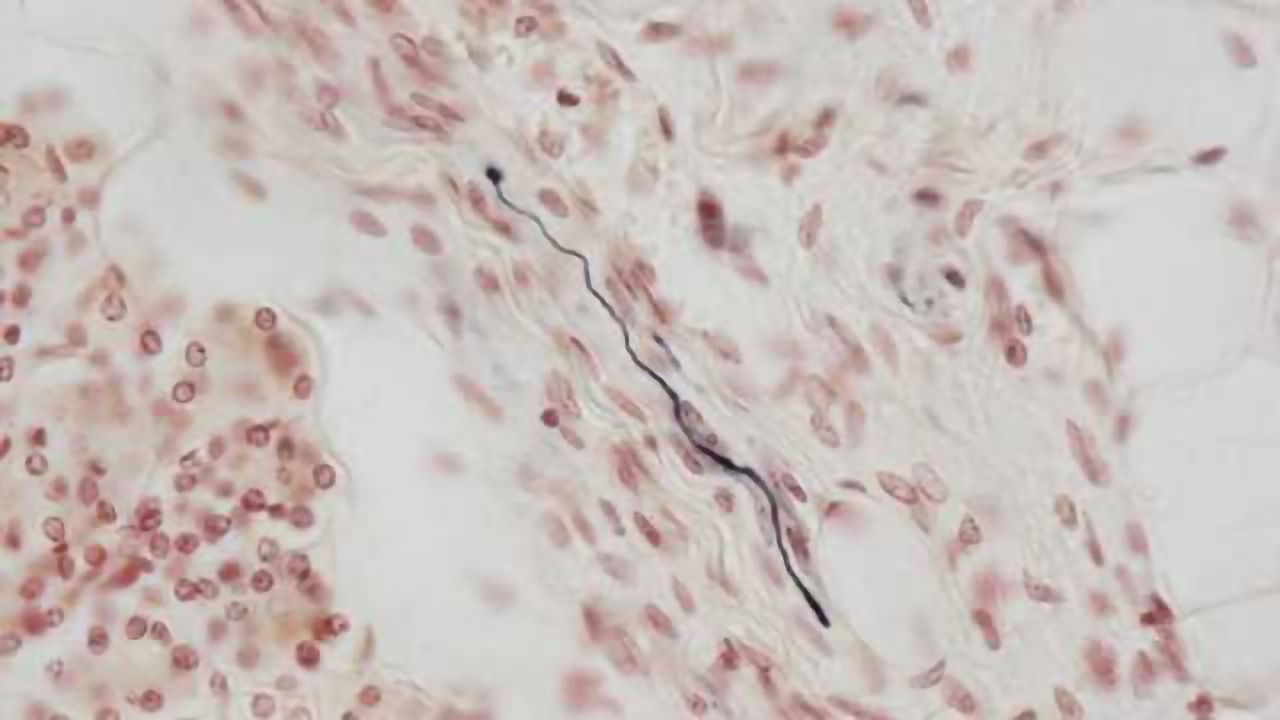Tissue biomarker for dementia with Lewy bodies and Parkinson's disease identified