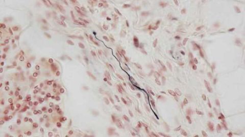 Tissue biomarker for dementia with Lewy bodies and Parkinson's disease identified