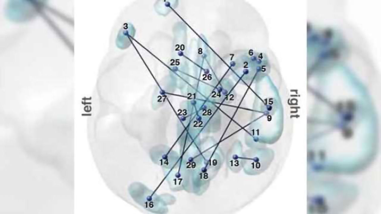 Brain scan method may help detect autism
