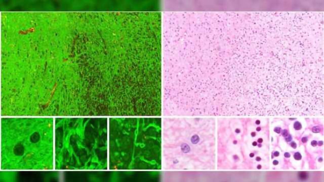 Shining light on brain tumors