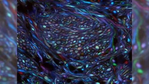 Mapping neurons to improve the treatment of Parkinson's