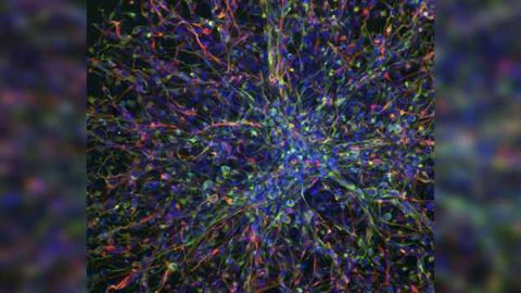 Critical immunotherapy target marks dysfunctional regulatory T cells in brain cancer