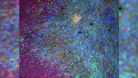 Experimental therapy halts treatment-resistant brain tumors