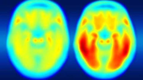 Brain imaging links Alzheimer’s decline to tau protein