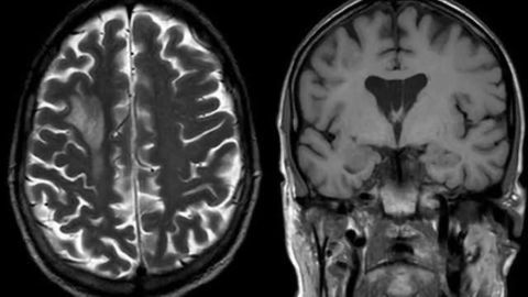 Researchers shed light on pathway from virus to brain disease