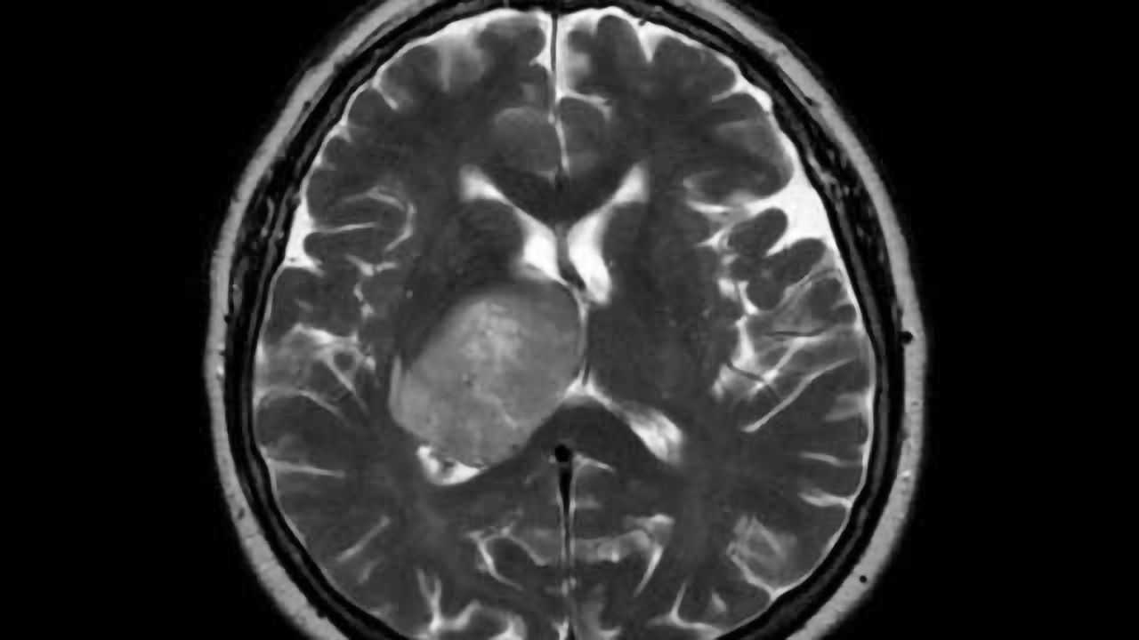 Tiny packages may pack powerful treatment for brain tumors