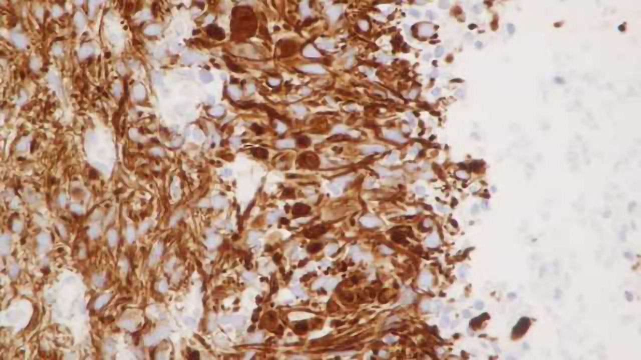 Vitamin E a potential biomarker for development of brain tumors