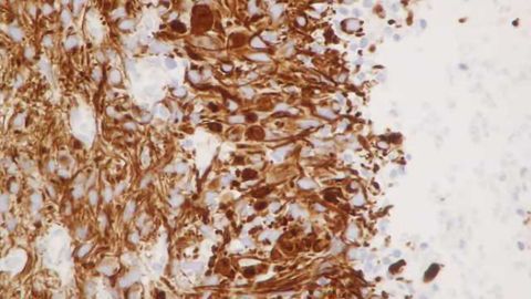 Vitamin E a potential biomarker for development of brain tumors