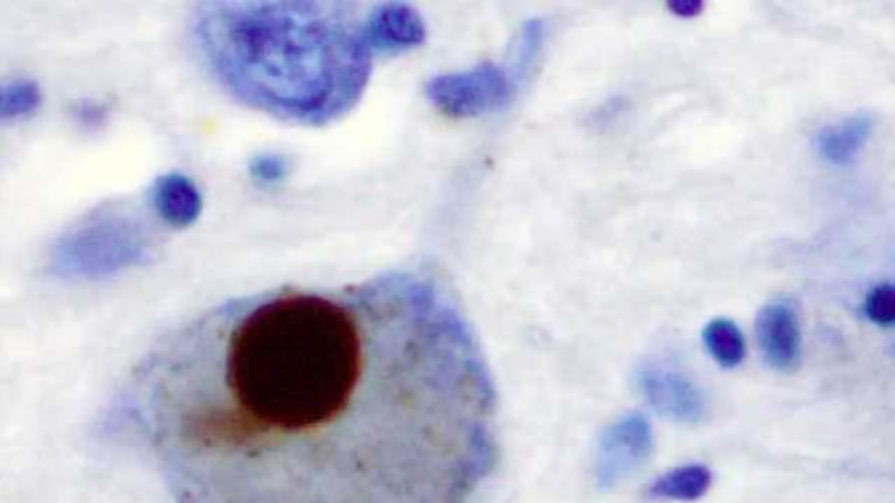 New study surveys genetic changes linked with Parkinson's disease