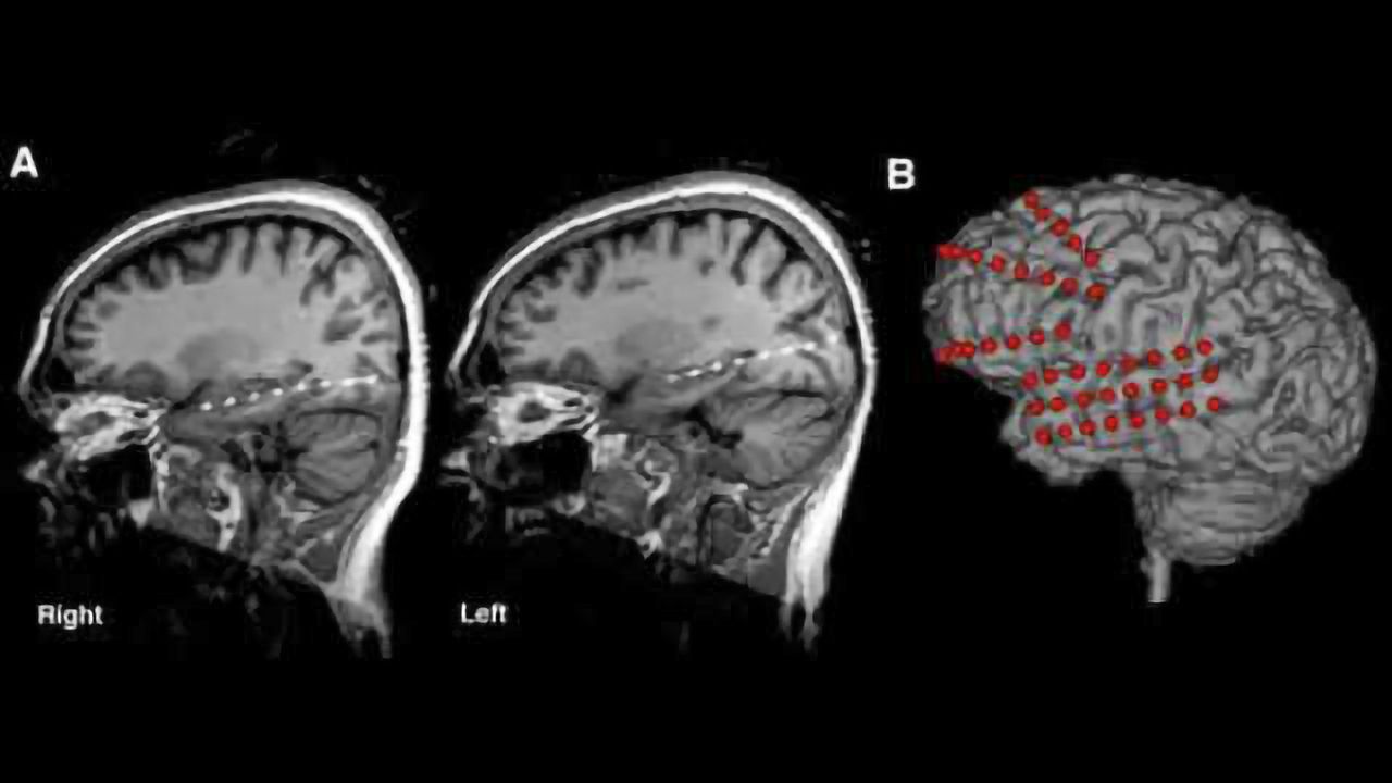 Crowdsourcing contest using data from people, dogs advances epileptic seizure forecasting