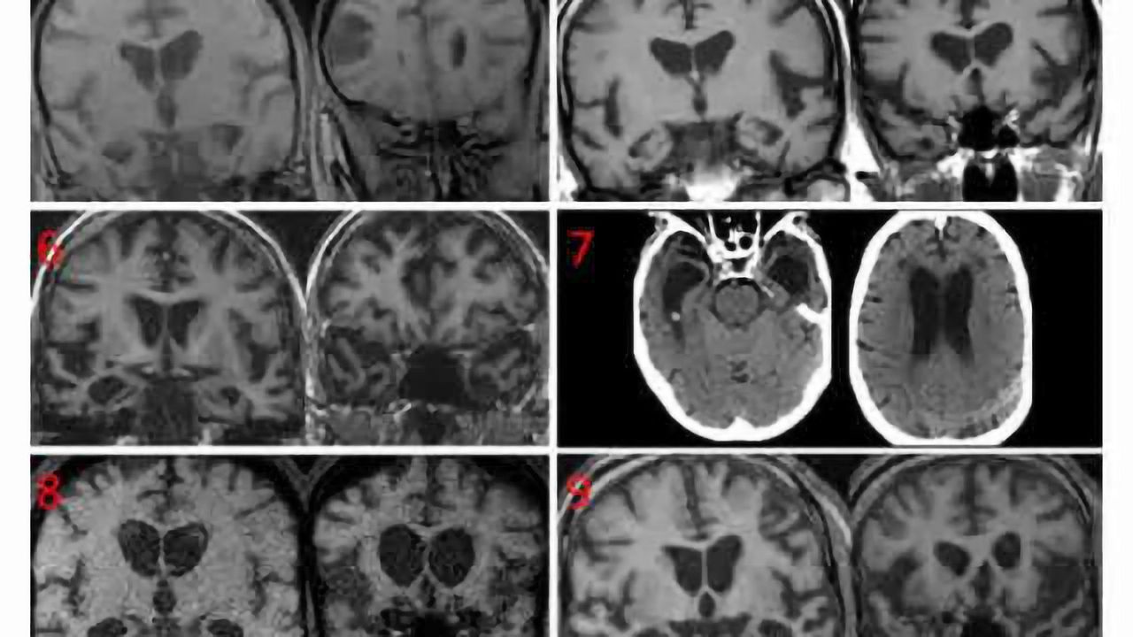 Brain scans of dementia patients with coprophagia showed neurodegeneration