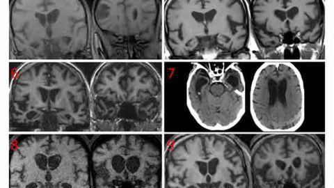 Brain scans of dementia patients with coprophagia showed neurodegeneration