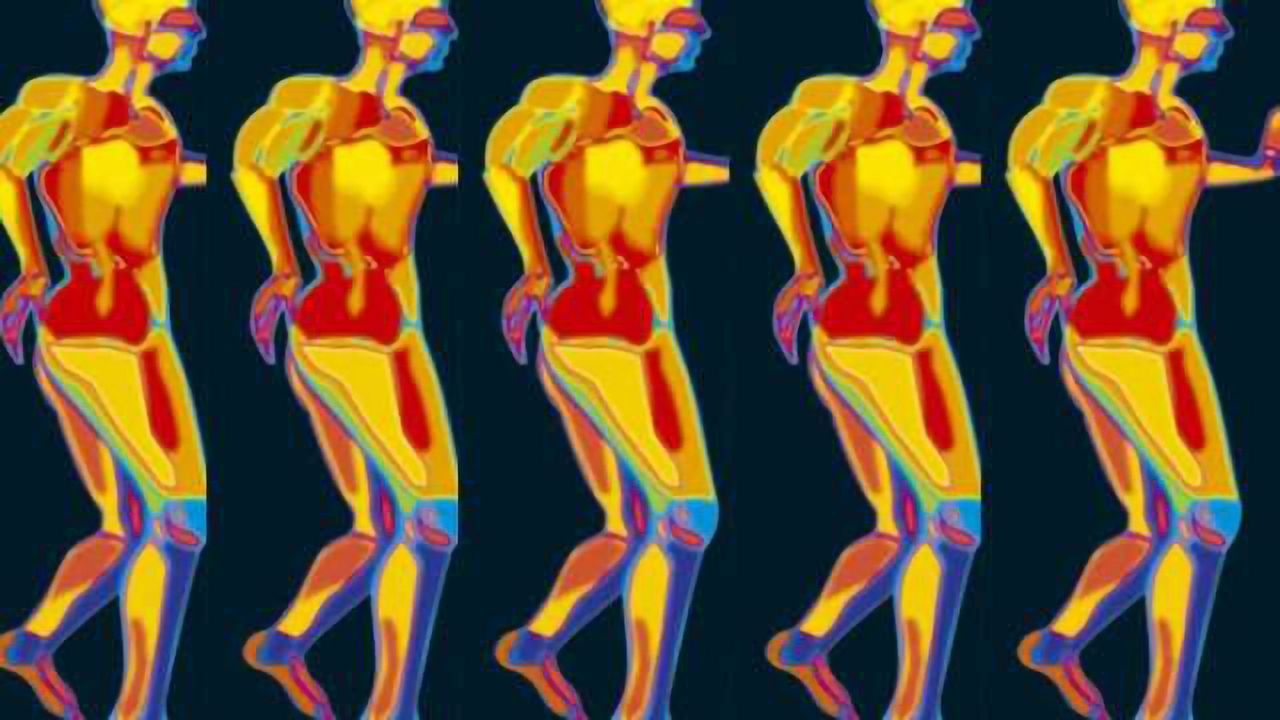 Implanted neuroprosthesis improves walking ability in stroke patient