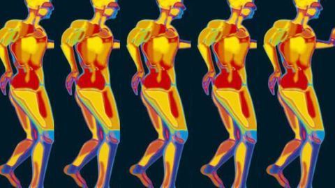 Implanted neuroprosthesis improves walking ability in stroke patient