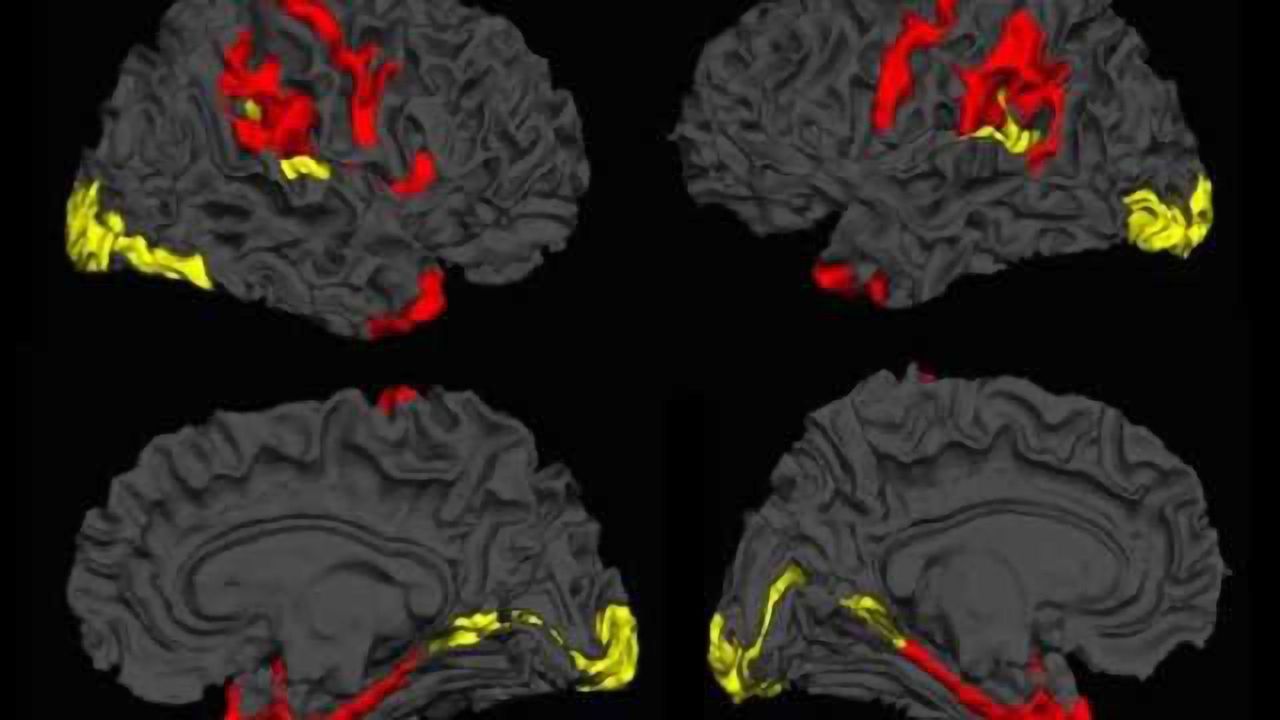 Imaging study shows promising results for patients with schizophrenia