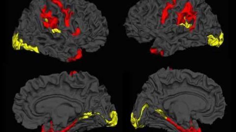 Imaging study shows promising results for patients with schizophrenia